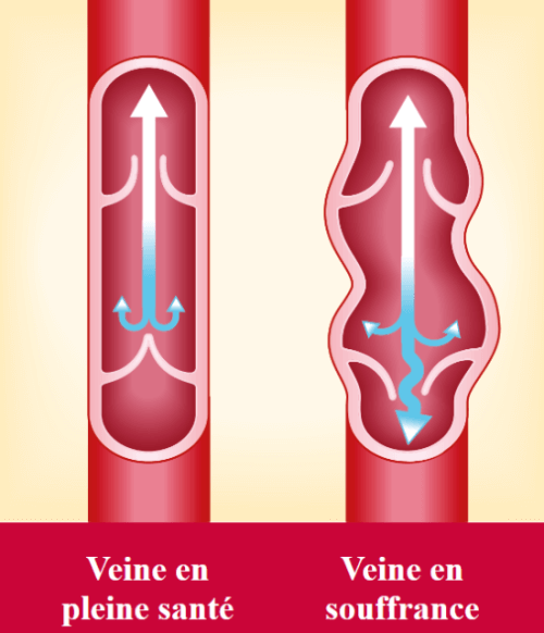 Veines douloureuses